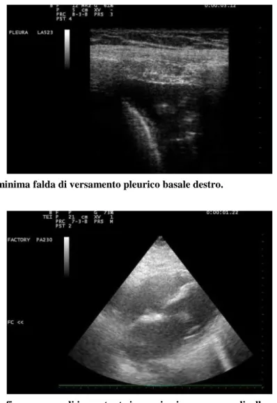 Figura 5. Ecocardiografia: presenza di importante immagine iperecogena a livello mitralico, determinante  insufficienza valvolare severa, verosimilmente compatibile con vegetazione