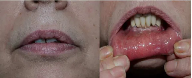 Figura  1.  Presenza  di  lesioni  crostose  del  vermiglione;  a  livello  della  porzione  mucosa  del  labbro  inferiore preseza di lesioni aftosiche, eritematose