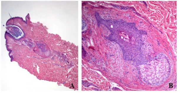 Figura 3. Aspetto istologico delle lesioni (colorazione con ematossilina e eosina): A) piccolo ingrandimento,  follicolo pilifero nel cui contesto si trova la proliferazione; B) maggiore ingrandimento, le cellule follicolari  proliferanti formano delle str