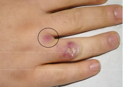 Figura 3. Lesione papulosa localizzata al III spazio interdigitale della mano destra (nel cerchio)