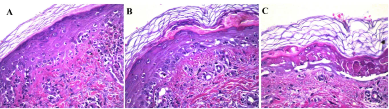 Figura 3. Reperti istologici da biopsia cutanea (E&amp;E): A) Dermatite dell’interfaccia con singoli cheratinociti  necrotici ed infiltrato infiammatorio misto nel derma papillare; B) Maggiore vacuolizzazione dello strato  basale associato a maggior numero