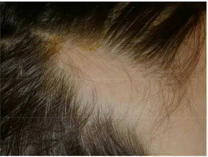 Figura  2.  Area  di  alopecia  triangolare  al  cuoio  capelluto  in  sede  temporale  destra