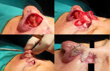 Figura  5.  Intervento  chirurgico:  asportazione  di  losanga  cutanea  e  riparazione  della  breccia  chi- chi-rurgica con lembo bilobato di rotazione