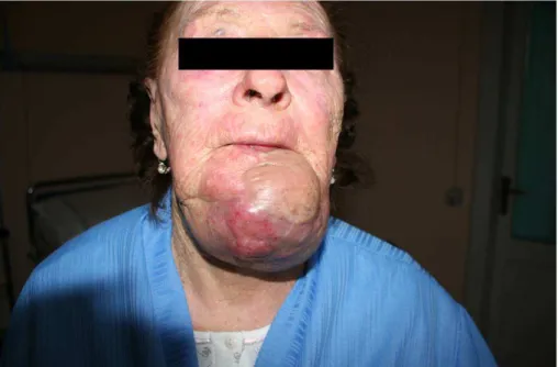 Figura 2. Paziente dopo due mesi dal trattamento chirurgico. Recidiva di malattia. 