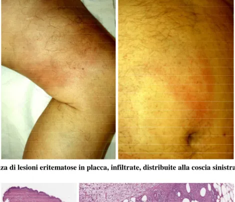 Figura 1. Presenza di lesioni eritematose in placca, infiltrate, distribuite alla coscia sinistra e all’addome