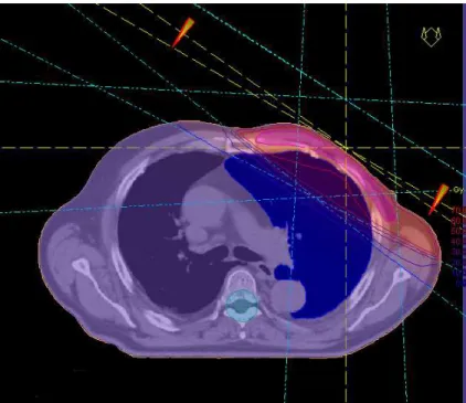 Figura  3.  Rappresentazione  grafica  di  piano  di  terapia  3DCRT,  con  curve  di  isodose  relative  al  90%,  95%,  100% e 107% della dose prescritta