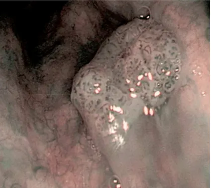 Figura 1. Lesione sospetta alla luce NBI caratterizzata da spot vascolari puntiformi e di varia forma.