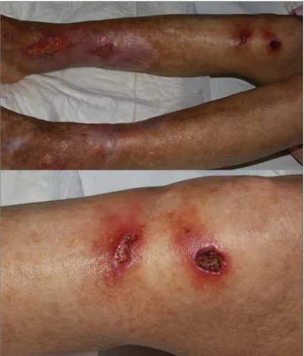 Figura 3. Ulcere a margini netti ai malleoli ed al ginocchio destro circondate da intensa flogosi perilesionale