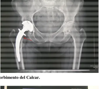 Figura 10. Esempio di addensamento corticale laterale con deformazione del profilo laterale del femore.