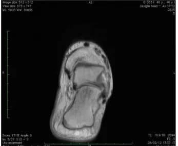 Figura 3. RMN caviglia sinistra a 3 mesi. Immagine T2 pesata che mostra pressochè totale risoluzione del quadro