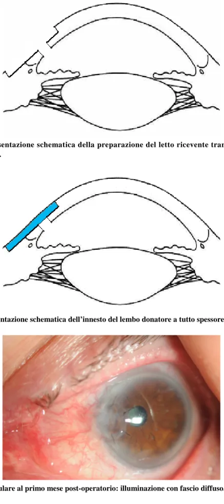 Figura 3. Rappresentazione schematica della preparazione del letto ricevente tramite slamellamen- slamellamen-to sclero-corneale