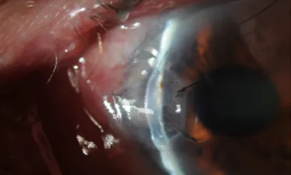 Figura 6. Bulbo oculare al primo mese post-operatorio: illuminazione con fessura stretta
