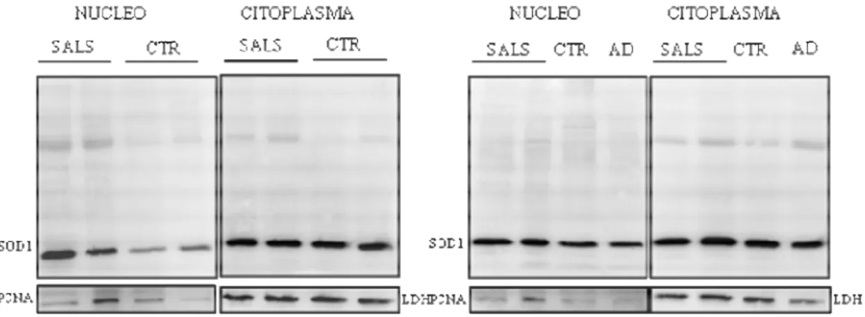 Figura 2. Immagini rappresentative di Western Blot: ciascuna costituita da due pannelli rappresentanti rispetti- rispetti-vamente l’espressione nucleare e citoplasmatica della proteina SOD1 nei pazienti e nei controlli, neurologici e non