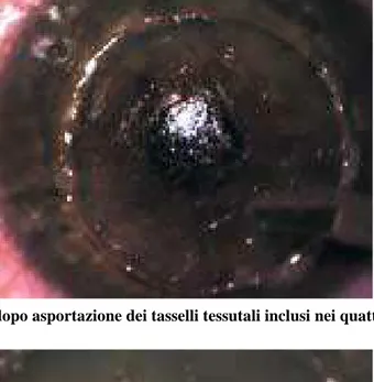Figura  5.  Separazione  dello  stroma  residuo  dal  sottostante  complesso  membrana  di  Descemet- Descemet-endotelio tramite slamellamento realizzato con la spatola smussa