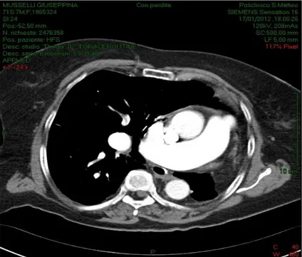 Figura  7.  Il  tronco  comune  delle  arterie  polmonari  è  ampio,  con  calibro  di  circa  34  mm;  il  cuore  destra non è ingrandito