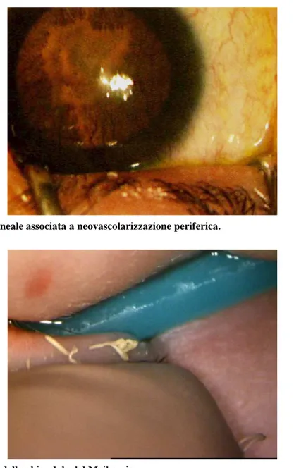 Figura 1. Opacità corneale associata a neovascolarizzazione periferica. 