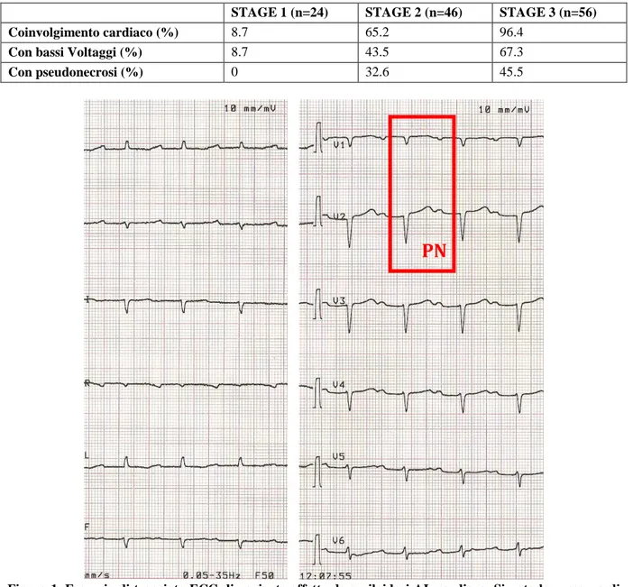 Tabella  2.  Prevalenza  di  coinvolgimento  cardiaco,  bassi  voltaggi  e  pseudonecrosi  all’interno  dei  3  stage  individuati dopo stratificazione della popolazione sulla base dei marcatori cardiaci (cTnI e NT pro-BNP) [13]