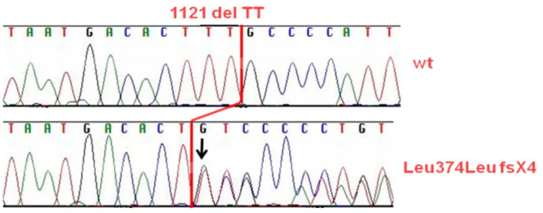 Figura 4. Delezione (1121 del TT) nell`esone 12 del gene GLMN. La sequenza del paziente studiato (paziente n  1) è confrontata con la sequenza di controllo (cromatogramma wt)