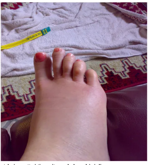 Figura 2. Sintomatologia caratteristica: eritema ed edema dei piedi. 