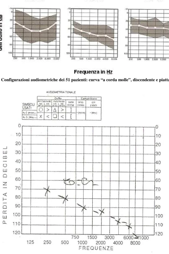 Figura 1. Configurazioni audiometriche dei 51 pazienti: curva “a corda molle”, discendente e piatta