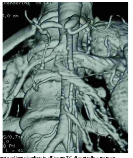 Figura 3. By-pass aorto-celiaco visualizzato all’esame TC di controllo a un mese. 