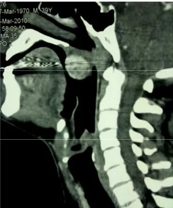 Figura  2.  Tumore  fibroso  solitario  extrapleurico,  proiezione  sagittale  immagine  TC