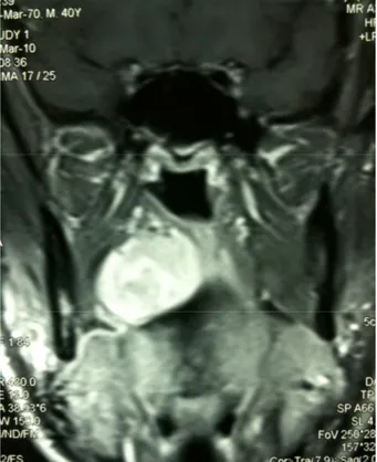 Figura 4. Tumore fibroso solitario extrapleurico, proiezione coronale immagine RMN. Ipointensità  del segnale nell’immagine T1 pesata con vivace C.E