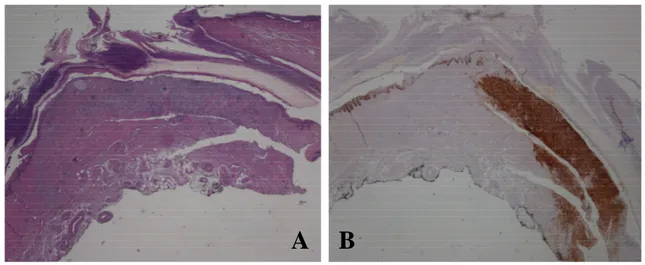 Figura 2. A) Gli elementi neoplastici infiltrano il derma reticolare e si estendono in senso longitudi- longitudi-nale per un tratto di 1 cm circa