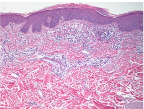 Figura 2. Aspetti istologici caratterizzati da infiltrato linfocitario dermico con aspetti in  banda alla giunzione dermo-epidermica e paracheratosi epidermica