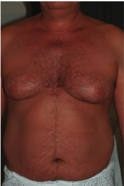 Figura 5. Paziente dopo la terapia: remissione cutanea completa (tronco; si segnala  la presenza di abbronzatura)