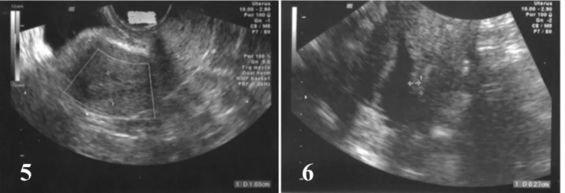 Figure 5 e 6. Iperplasia endometriale. 
