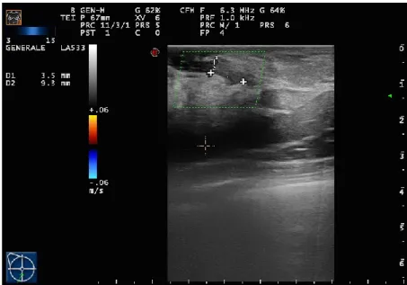 Fig. 3. L’esame RM evidenziava a destra, in sede retro-areolare, un enhancement  tubulare esteso per circa 8 mm (sequenze T1-W dopo mdc)
