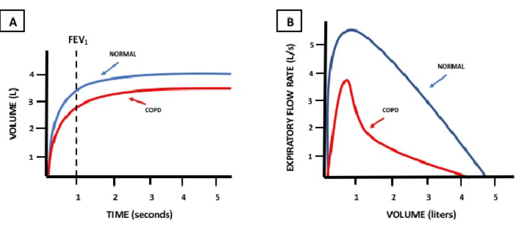 Fig  2:  In  part  A,  the  characteristic  decrease  of  FEV 1   in  people  presenting  airflow  obstruction,  as  in  COPD;  in  part  B,  the  typical  curve  representing airflow obstruction