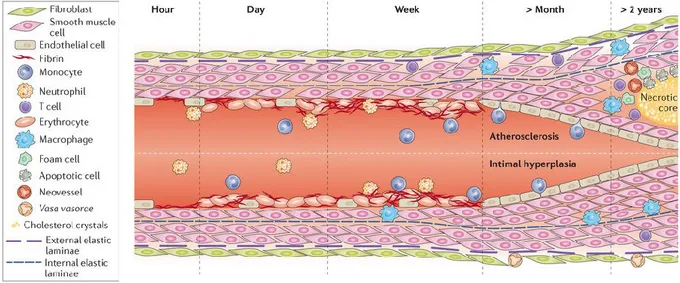 Figure  5  Intimal  hyperplasia  evolution.  The endothelial layer is easily damaged due to the new hemodynamic  condition