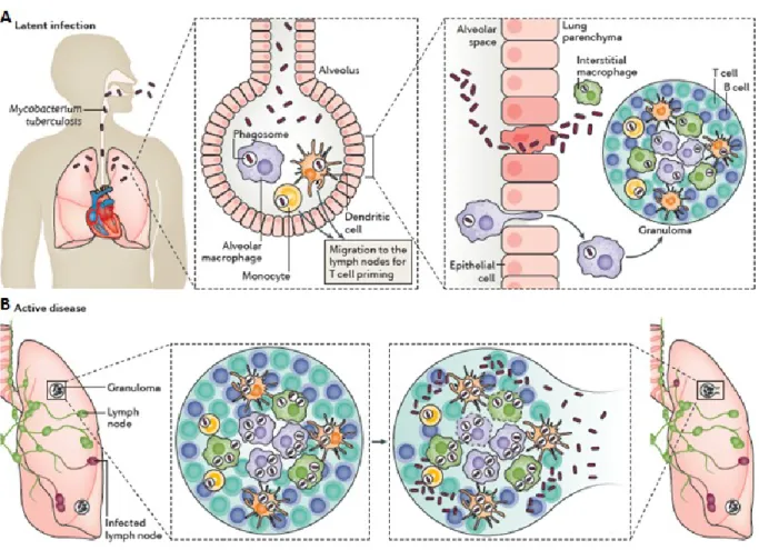 Figure 1.3: Mycobacterium tuberculosis infection. (A) The Infection begins when M. tuberculosis enters the lungs  via inhalation, if this first line of defence fails to eliminate the bacteria, M