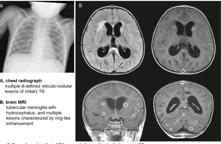 Figure 3. Chest radiograph and brain MRI images of a 2-year-old girl with disseminated TB.