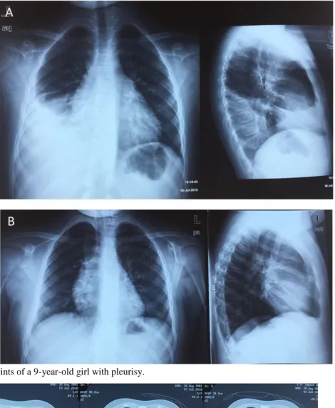 Figure 5. Chest TC images of 9-year-old girl with pleurisy at the time of TB diagnosis