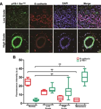 Figure 1: YB-1 expression increases with increase  in tumor grade and is negatively correlated with  E-cadherin expression in human PCa tissues