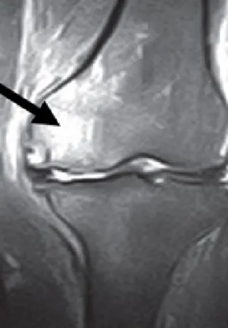 Figure 1 - A typical case of bone marrow lesion in  femoral condyle