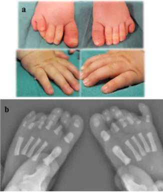 Figure 3 - Clinical (a) and  radiological (b)  findings   at birth: post-axial extra-digits in feet and post-axial  bump in hands.