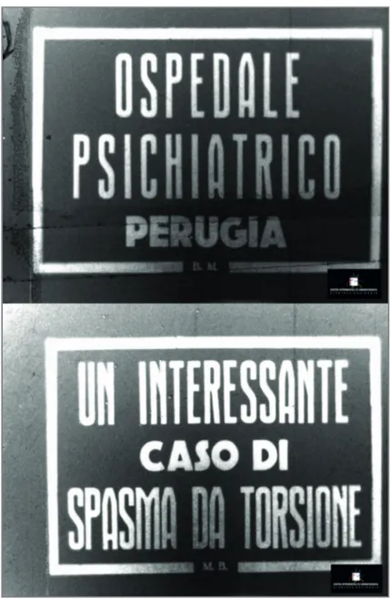 Fig. 1 -  “Un interessante   caso di spasma   da torsione” (1937)   di Mario Bencivenga