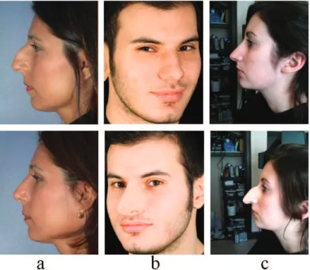 Figure 6.1: Examples of nose alterations with before (upper row) and after (lower row) photos: (a) plastic surgery [133] (b) latex appliance [120] (c) makeup using wax [19]