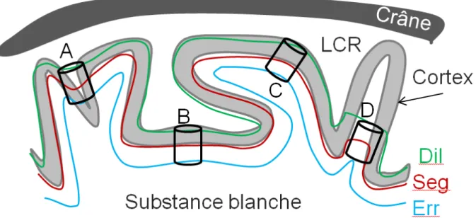 Figure  20.  Mesure  de  contraste  local  entre  le  cortex,  la  substance  blanche  et  le  LCR
