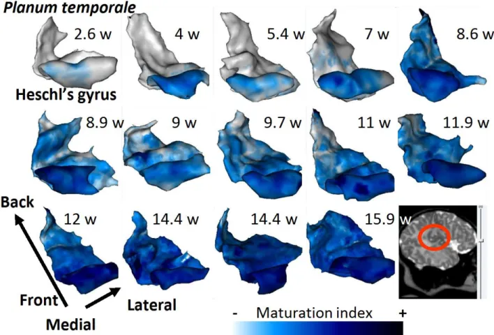 Figure 51. Illustration of the effect of age on the maturation index. The maturation index of the adjacent  cortex is projected on 3-D meshes of the left  planum temporale and Heschl’s gyrus in the 14 infants ordered  by  age