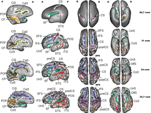 Figure  5.  Illustration  de  l’apparition  des  sillons  sur  l’interface  gris-blanc  de  cerveaux  de  nouveau-nés  prématurés  d’âge  gestationnel  et  de  niveau  de  sulcation  différents  [Dubois,  2008b]