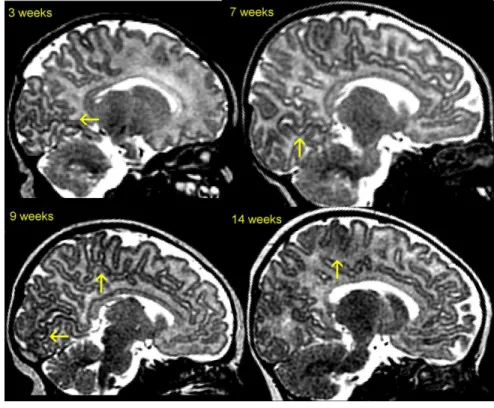 Figure  20.  Infant  brain  maturation  across  age  in  T2w  MRI.  These  sagittal  slices  show  temporo-spatial  variations  of  the  on-going  maturation  processes  near  the  inter-hemispheric  plane