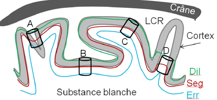 Figure  27.  Mesure  de  contraste  local  entre  le  cortex,  la  substance  blanche  et  le  LCR