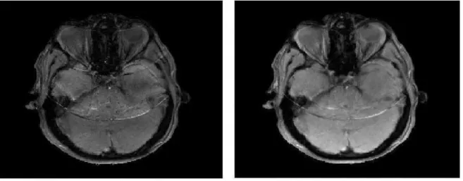 Fig. III.21 – Images reconstruites par r´egularisation quadratique (` a gauche) et par r´egularisation dans l’espace ondelette pour des donn´ees acquises avec un facteur de r´eduction R = 4.