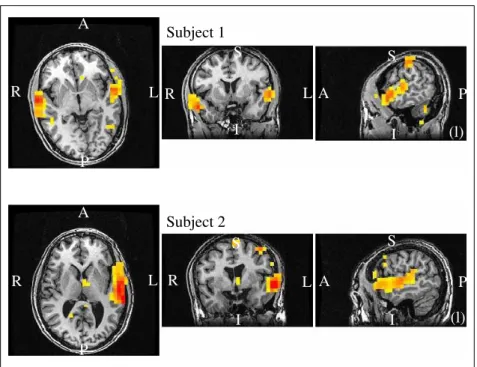 Fig. III.25 – Cartes d’activation superpos´ees ` a l’anatomie c´er´ebrale de deux sujets, et seuill´ees