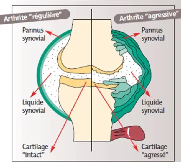 Figure 6. Schéma d’une articulation normale et arthritique. 